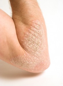 picture of psoriasis lesion on the elbows with white scale and redness