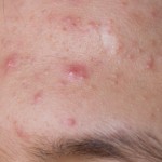 image man forehead acne pimples